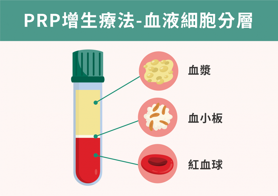 PRP療法：血液細胞分層