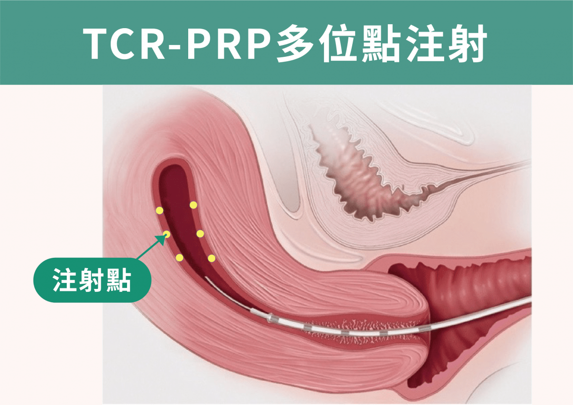 新一代子宮內膜內注射TCR-PRP