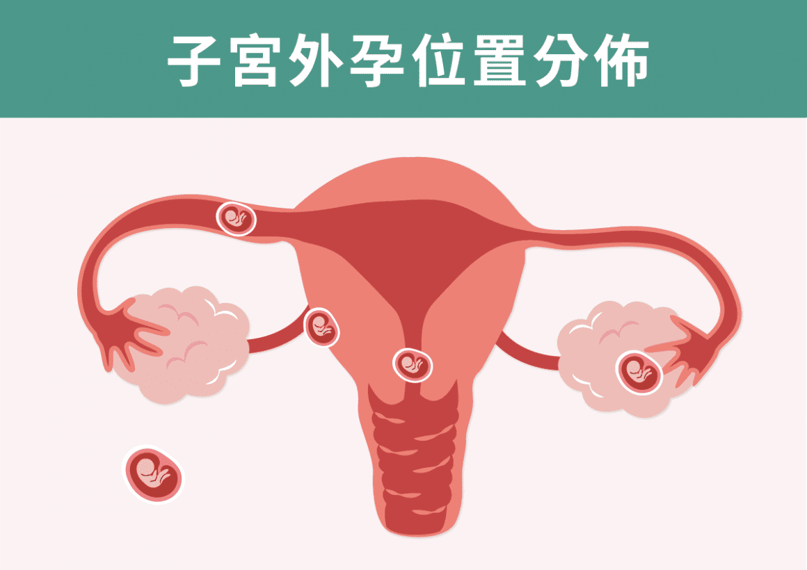 宮外孕位置分佈