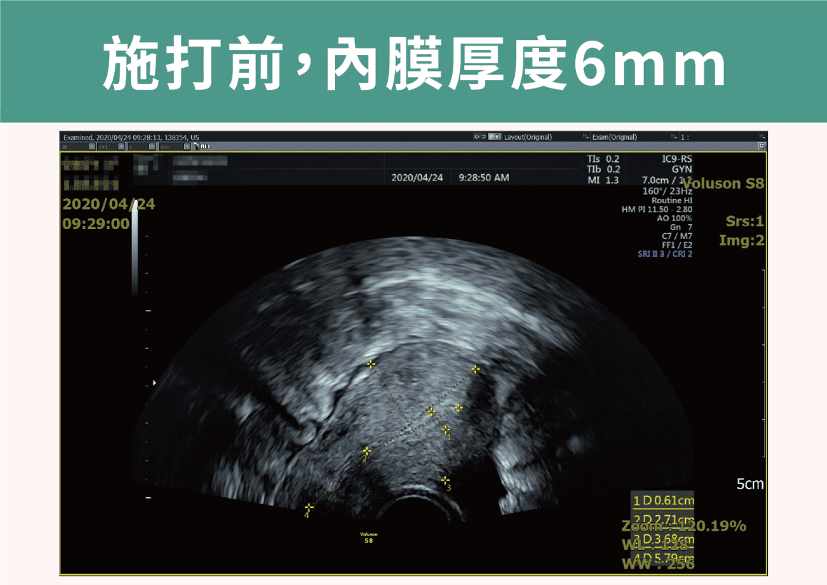 茂盛醫院-施打前子宮內膜厚度6mm (1)