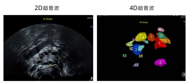 4D超音波和2D超音波中的卵巢影像
