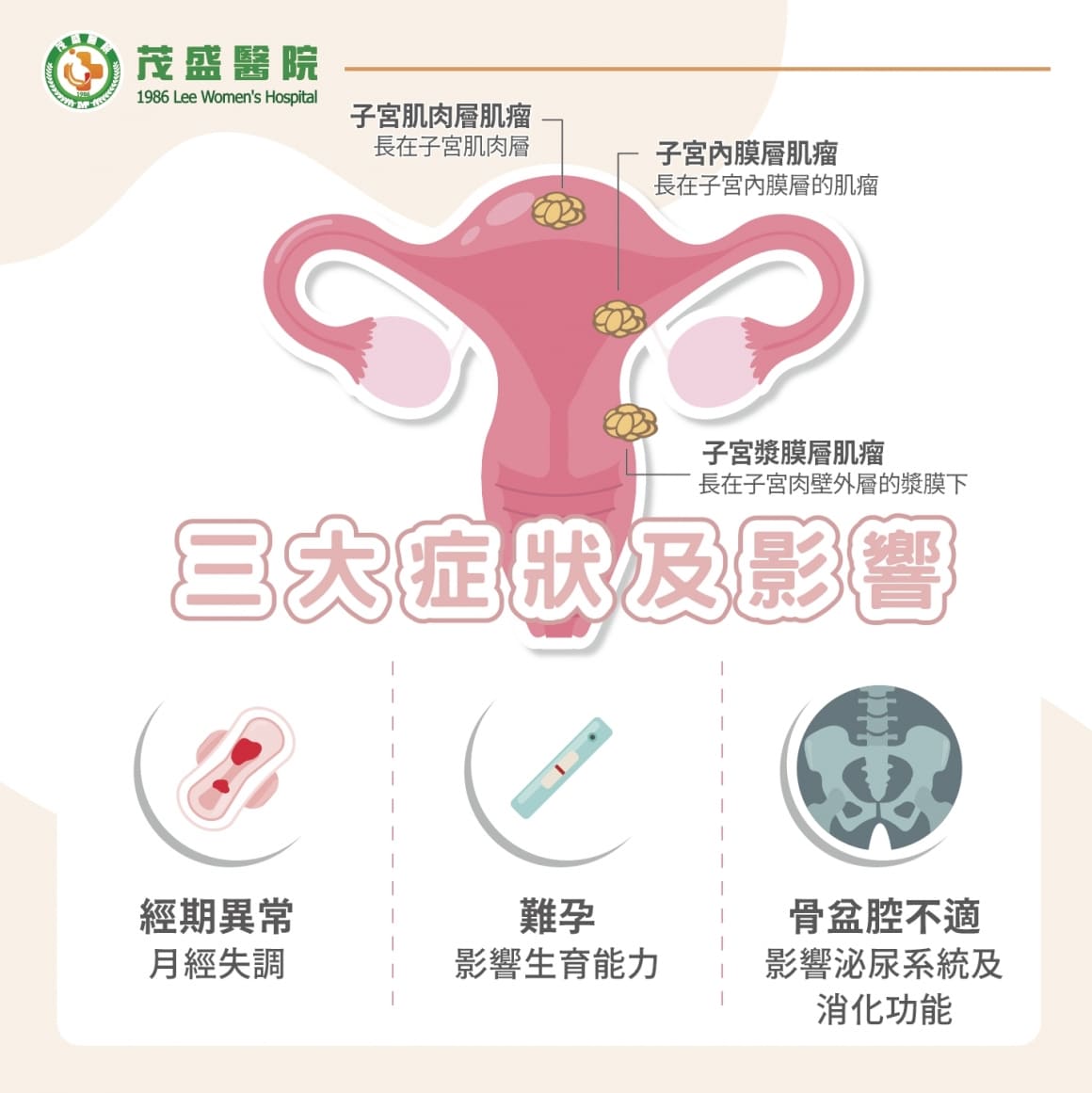 子宮肌瘤症狀 子宮肌瘤症狀